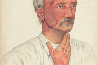 A man with disease designated as Lupus erythematosus