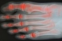 Foot xray RA